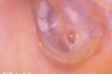 Amplituner cyfrowy do ucha i nosa Otoskop cyfrowy do perforacji błony bębenkowej