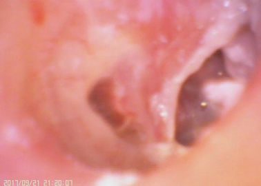 Cyfrowy Otoskop Wideo Zestaw do infekcji ucha diagnostycznego i perforacji ucha