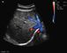 Przenośny aparat ultrasonograficzny ciąży z przetokami transvaginalnymi w jamie brzusznej