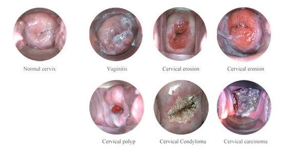 Przenośny cyfrowy kolposkop elektroniczny