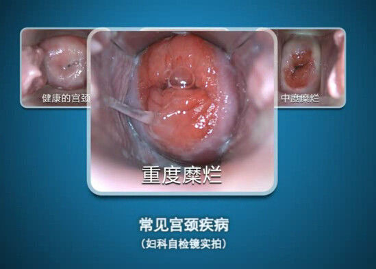 Mini-kolposkopia z endoskopem cyfrowym i samokontrolą z zakresem obserwacji 70 ~ 100 mm