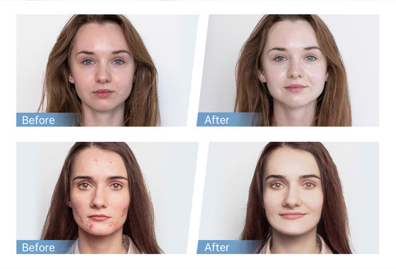 Najnowszy 4-polarny EMS Automatcal Serum Applicator Hydra Pen H5 Twarz Skóra Derma Mikroneedling Pen Essence Regeneracja kolagenu